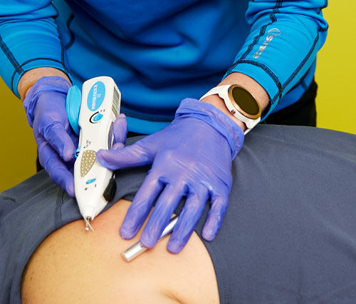 Dry needling for physical therapy